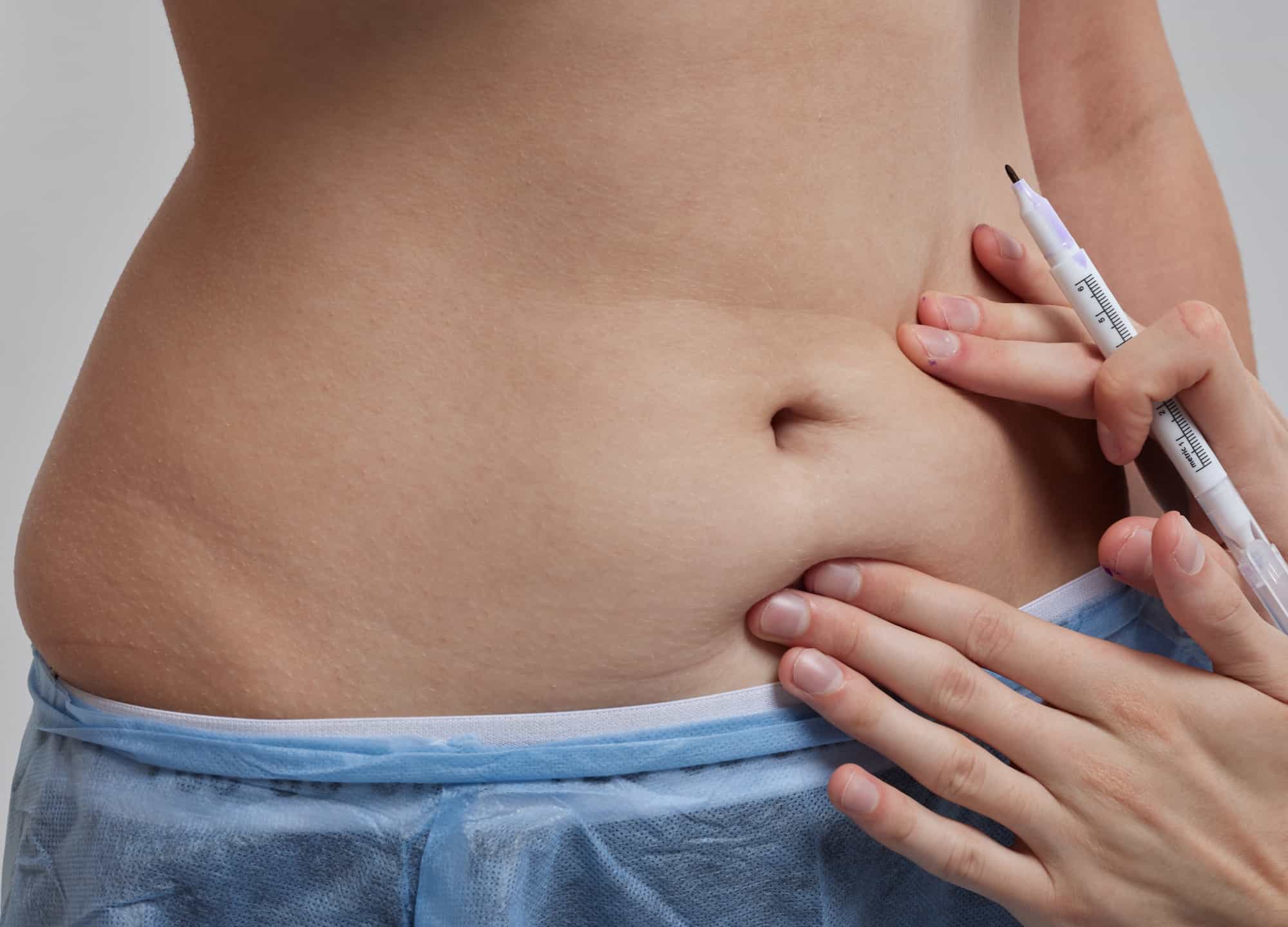 أسباب الوفاة المحتملة بعد عملية شد البطن