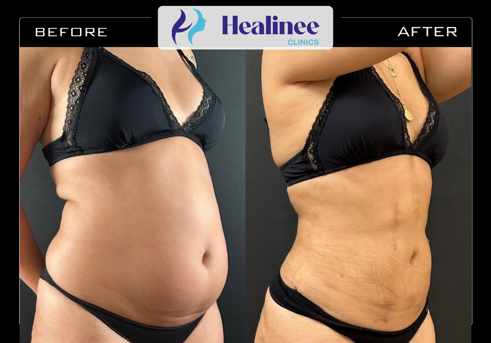 شفط دهون البطن قبل وبعد بالصور