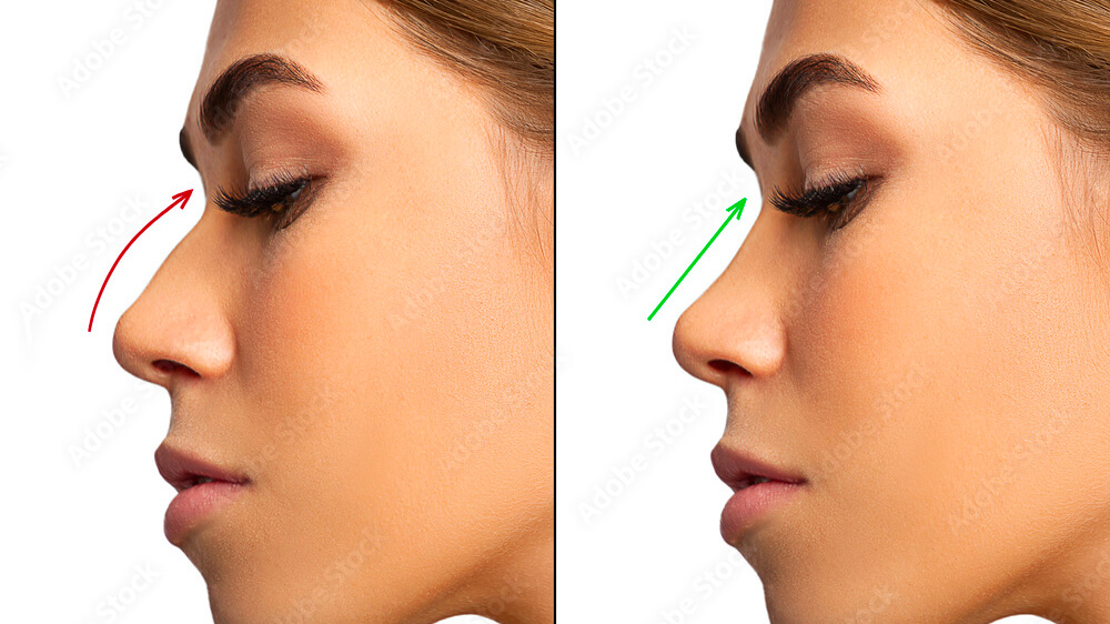 متى تظهر النتيجة النهائية للأنف بعد عملية التجميل؟