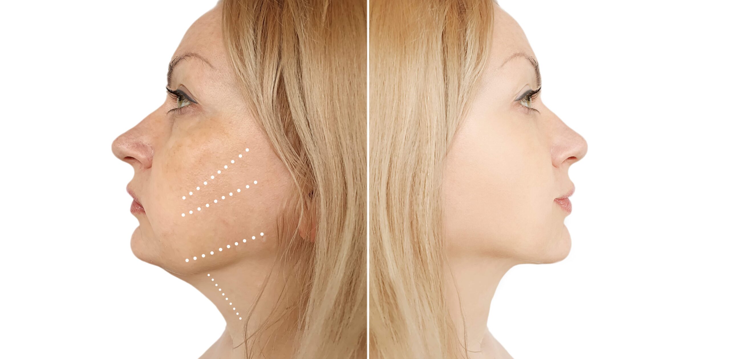 ما هي عملية شد الرقبة؟