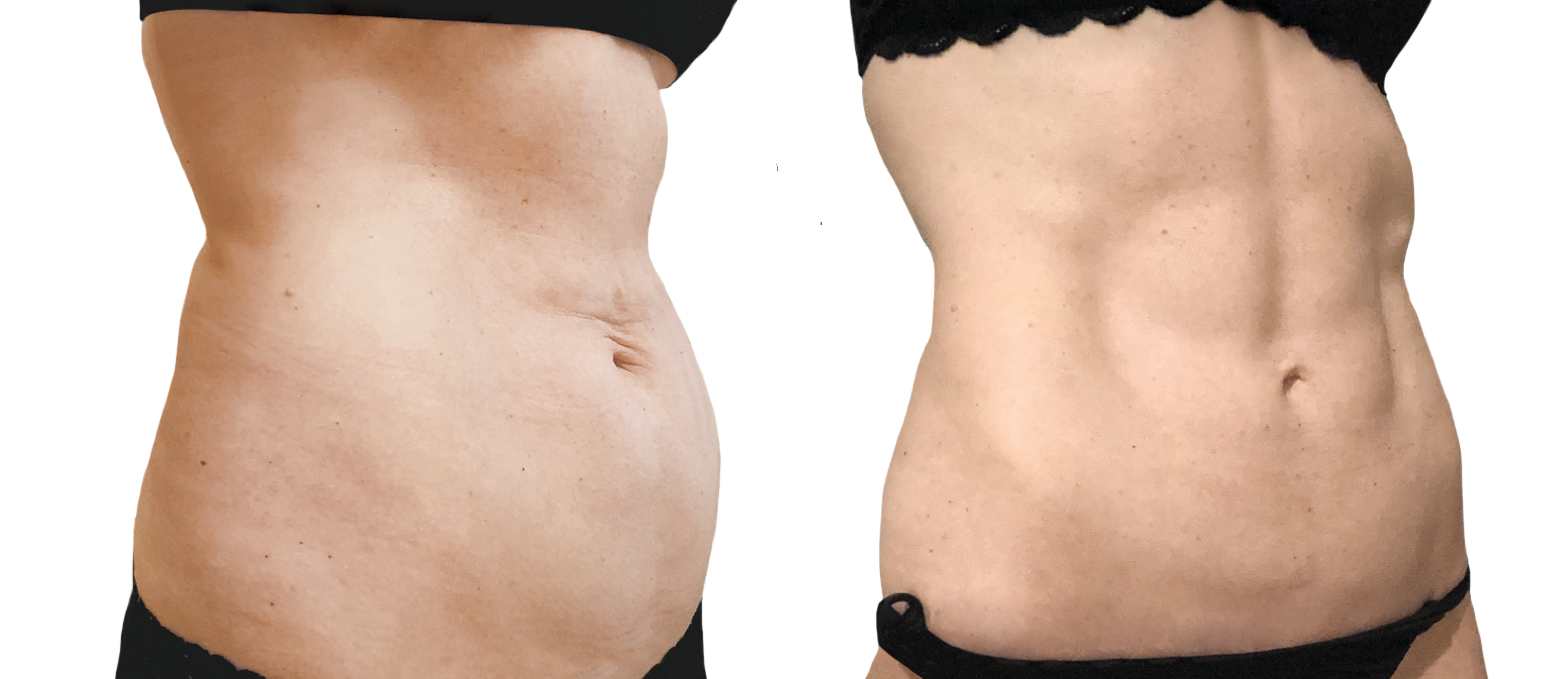 فوائد عملية شفط دهون البطن