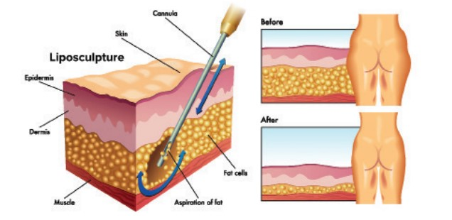 ما هي عملية شفط دهون البطن؟