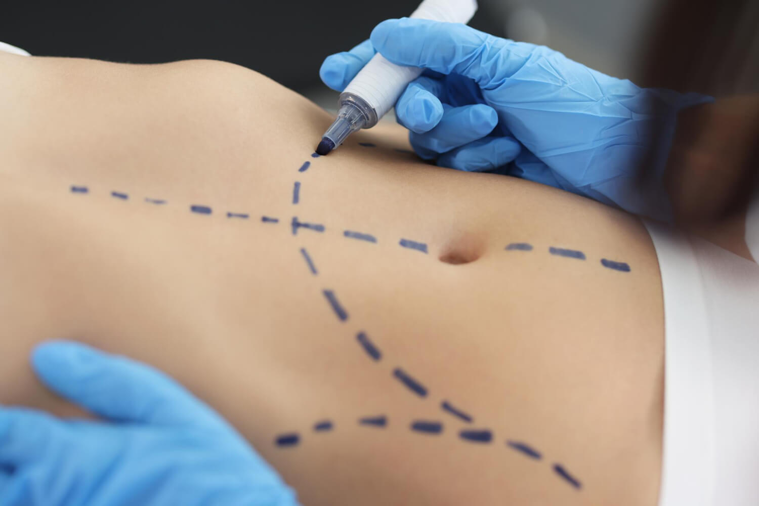 خطوات عملية شفط دهون البطن