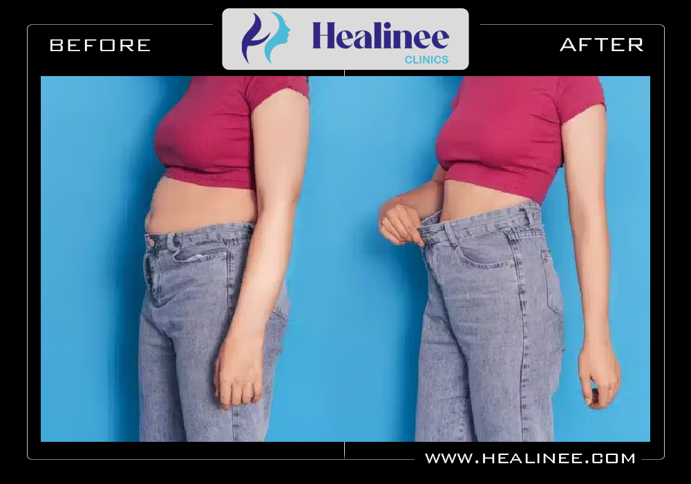 تجربتي مع شفط الدهون في تركيا قبل وبعد بالصور