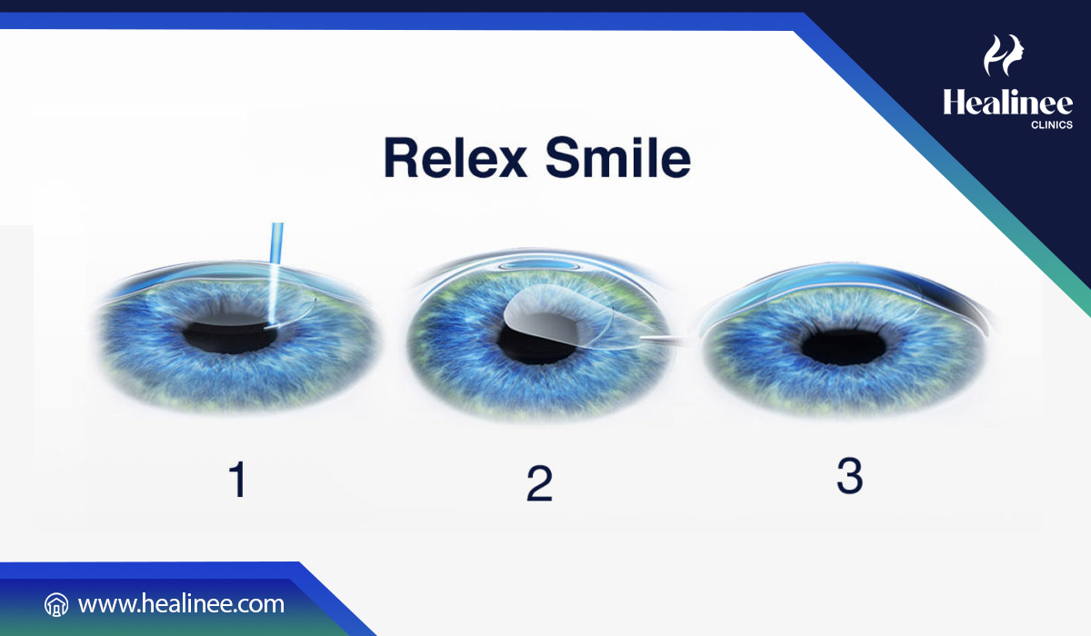 تقنية سمايل ليزك (ReLEx SMILE) في تركيا: المميزات، العيوب، وخطوات العملية
